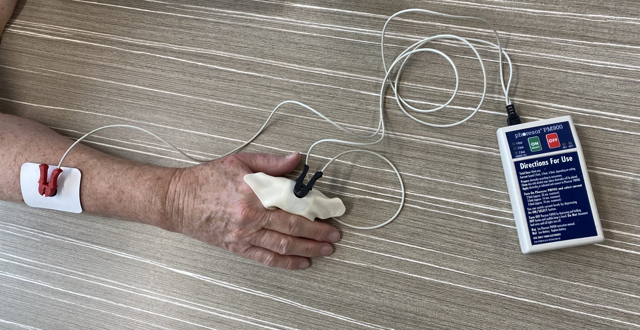 Iontophoresis Peninsula Hand Therapy